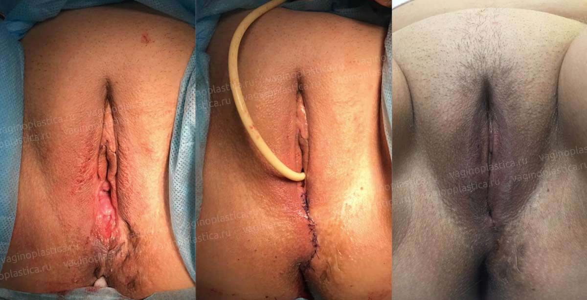 Mtf Vagina Rehabilitation.