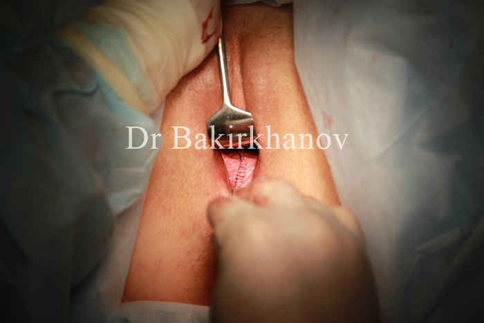 Пластика влагалища (вагнопластика) в Москве – цена, сделать операцию в клинике «Будь Здоров»